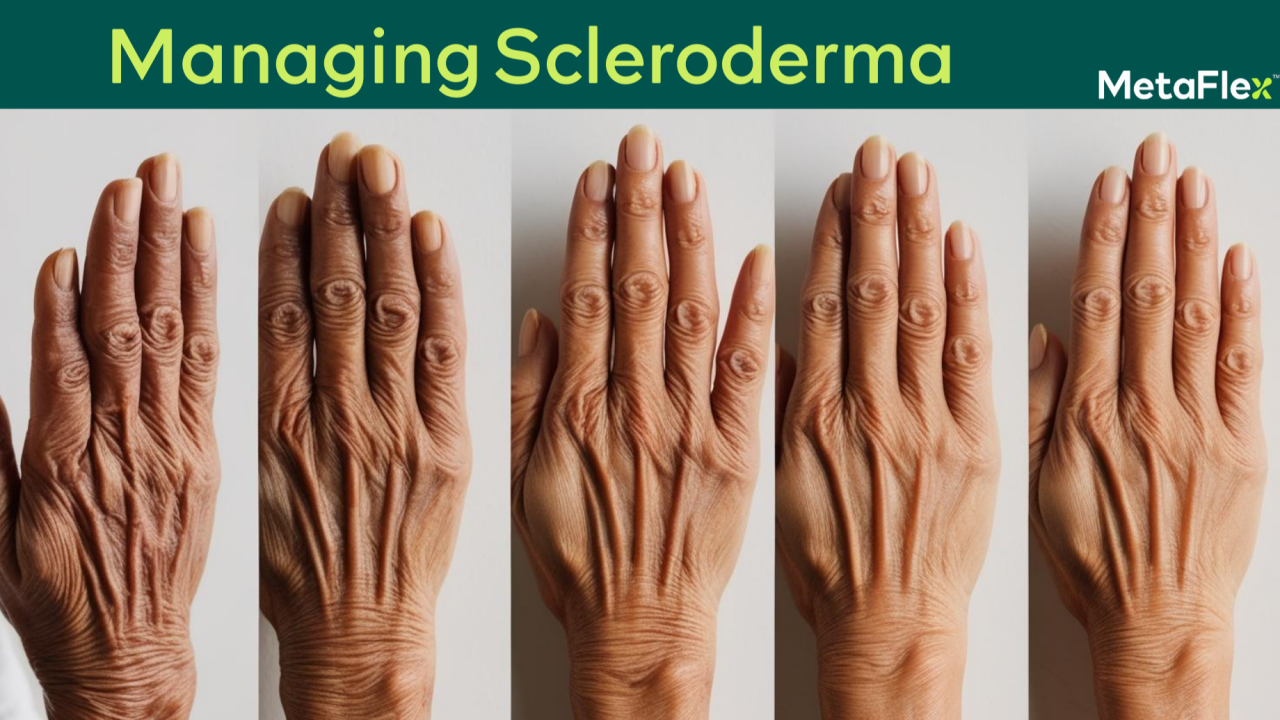 Managing Scleroderma of the Hands with the Metaflex Glove: A PDAC-Approved Solution